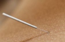 acupuncture