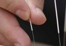Disease Treated By Acupuncture
