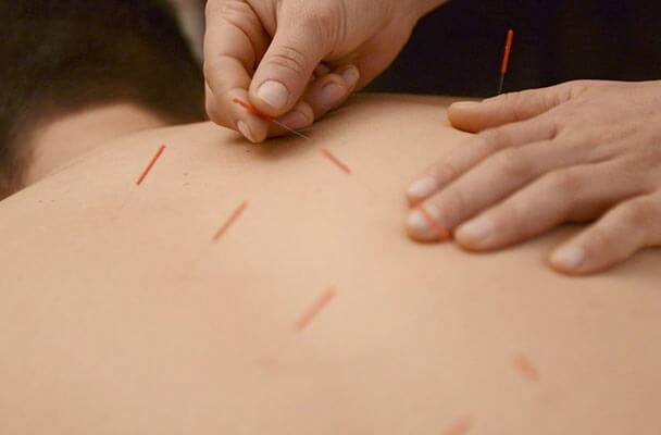 Acupuncture on Back